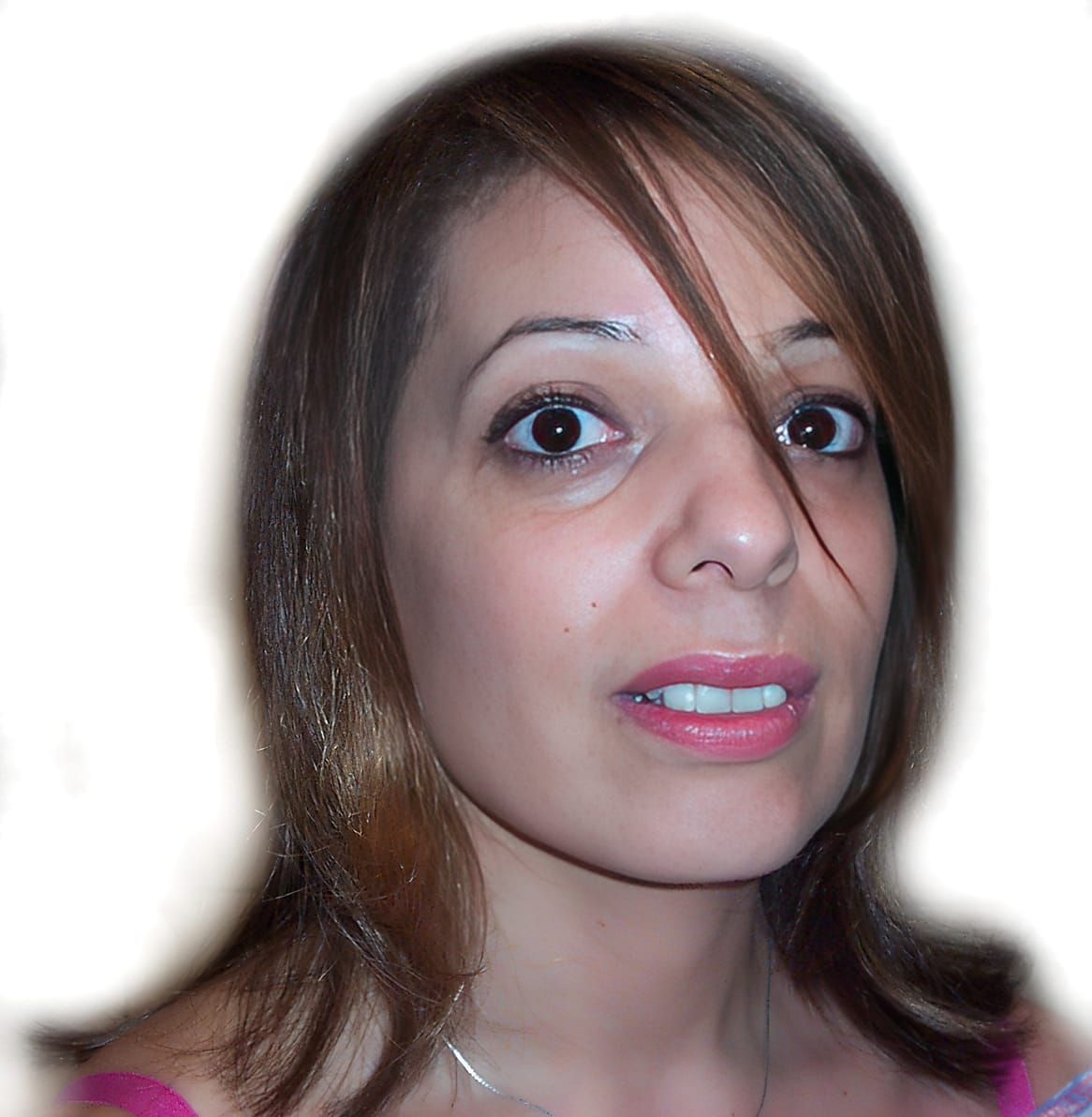 After Picture - Alopecia Areata